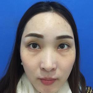 超雅超 声 波去眼袋手术做得好成功 超雅超 声 波去眼袋手术做得好成功