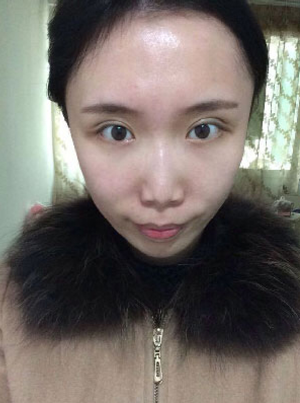 代替传统双眼皮方式，尽情享受超声波双眼皮带来的美丽385