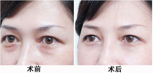 老年人也爱美,去掉眼袋重获美丽!278 老年人也爱美,去掉眼袋重获美丽!278