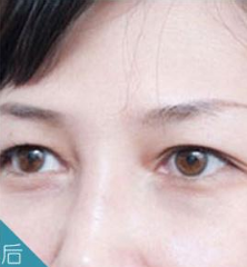超声波祛眼袋让环卫临时工不再烦恼眼袋了114 超声波祛眼袋让环卫临时工不再烦恼眼袋了114