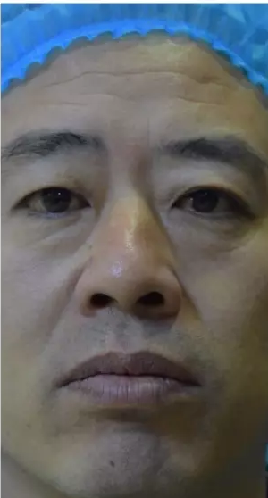超声波去眼袋效果不错,儿科医生也去做803 超声波去眼袋效果不错,儿科医生也去做803