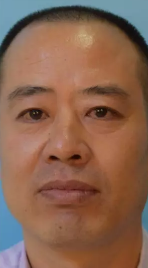 超声波去眼袋效果不错,儿科医生也去做803 超声波去眼袋效果不错,儿科医生也去做803