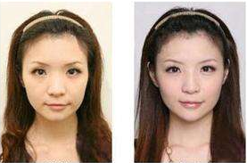 超声波自体脂肪丰面 我不再是干瘪脸239 超声波自体脂肪丰面 我不再是干瘪脸239
