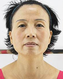 超声波自体脂肪丰面 年轻自信了674 超声波自体脂肪丰面 年轻自信了674