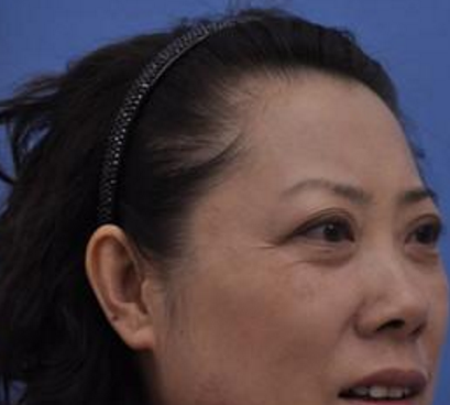 中年大妈的快乐祛眼袋方法分享:超声波祛眼袋693 中年大妈的快乐祛眼袋方法分享:超声波祛眼袋693