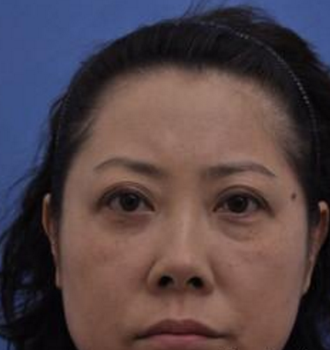 中年大妈的快乐祛眼袋方法分享:超声波祛眼袋693 中年大妈的快乐祛眼袋方法分享:超声波祛眼袋693