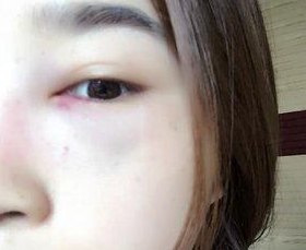 超声波去眼袋后眼袋再也不是心病了643 超声波去眼袋后眼袋再也不是心病了643