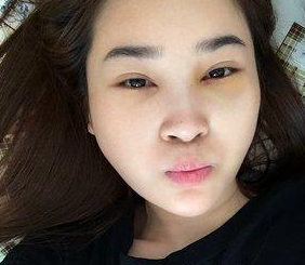 超声波去眼袋后眼袋再也不是心病了643 超声波去眼袋后眼袋再也不是心病了643