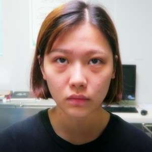 超声波去眼袋——超有效的去眼袋手术355 超声波去眼袋——超有效的去眼袋手术355
