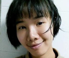 超 声 波去眼袋后黑眼圈减轻le,卧蚕清晰le 超 声 波去眼袋后黑眼圈减轻le,卧蚕清晰le