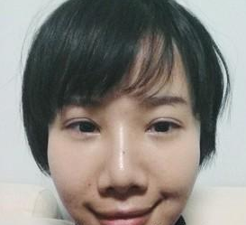 超 声 波去眼袋后黑眼圈减轻le,卧蚕清晰le 超 声 波去眼袋后黑眼圈减轻le,卧蚕清晰le