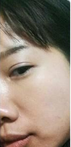 超 声 波去眼袋后黑眼圈减轻le,卧蚕清晰le 超 声 波去眼袋后黑眼圈减轻le,卧蚕清晰le