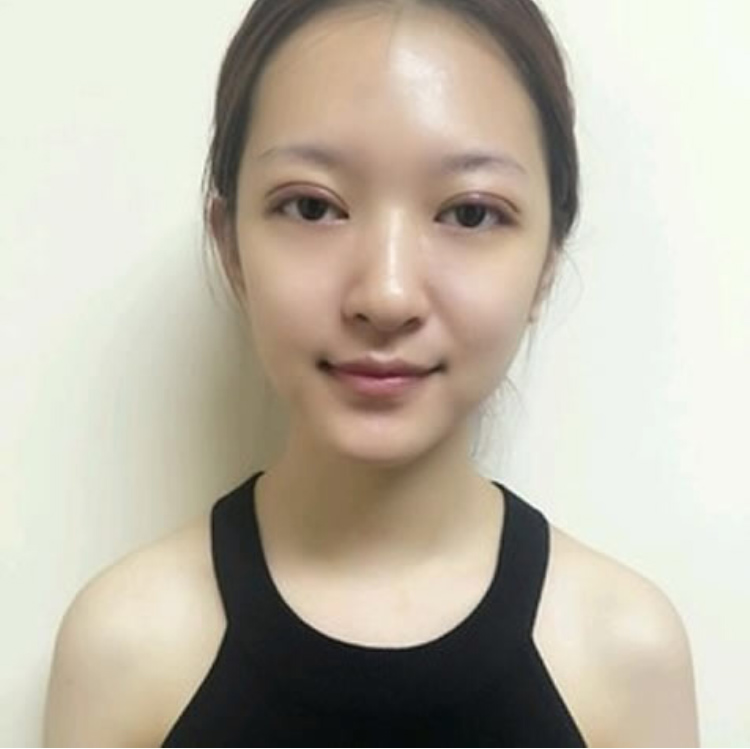 超 声 波双眼 皮提升你得外眼角 超 声 波双眼 皮提升你得外眼角