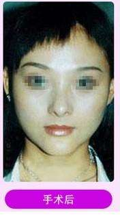 超 声 波瘦脸 变巴掌小脸