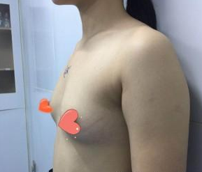 贫乳变形记——超 声 波自体脂肪丰胸 贫乳变形记——超 声 波自体脂肪丰胸