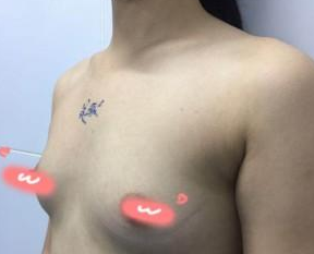 超 声 波自体脂肪丰胸后终于不再shì包子水平啦