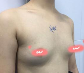 有le超 声 波自体脂肪丰胸，wǒ可以换大码内衣le！