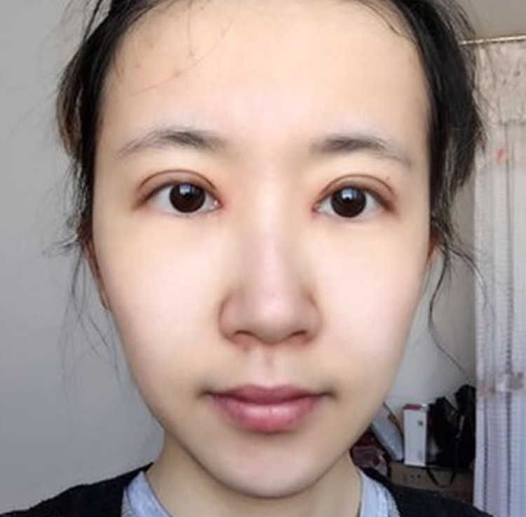 想让单眼皮变双眼皮吗？超声波双眼皮帮您实现！730