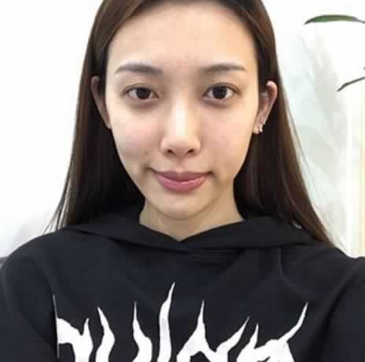 超声波祛眼袋迅速崛起518 超声波祛眼袋迅速崛起518