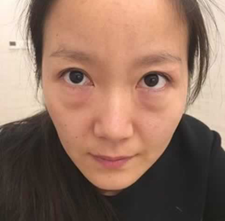 去眼袋让你年轻十岁不是难题，超声波去眼袋帮助你成功去除眼袋548