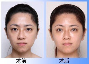 超声波祛眼袋,亲身经历告诉你妙招所在251 超声波祛眼袋,亲身经历告诉你妙招所在251