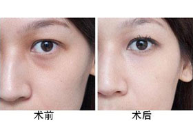 超声波祛眼袋,亲身经历告诉你妙招所在251 超声波祛眼袋,亲身经历告诉你妙招所在251