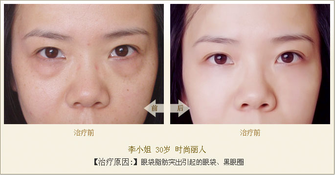 超声波祛眼袋,亲身经历告诉你妙招所在251 超声波祛眼袋,亲身经历告诉你妙招所在251