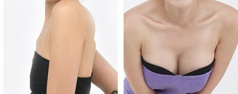 超声波自体脂肪丰胸是丰胸美乳的好方法!319 超声波自体脂肪丰胸是丰胸美乳的好方法!319