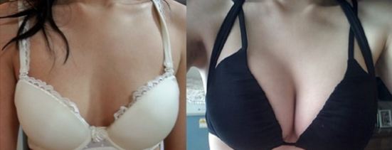 超声波自体脂肪丰胸是丰胸美乳的好方法!319 超声波自体脂肪丰胸是丰胸美乳的好方法!319