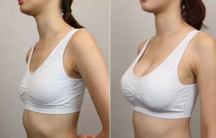 科学合理健康丰乳方法——超声波自体脂肪丰胸487 科学合理健康丰乳方法——超声波自体脂肪丰胸487