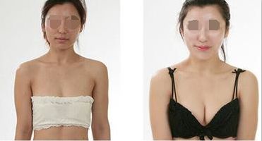 科学合理健康丰乳方法——超声波自体脂肪丰胸487 科学合理健康丰乳方法——超声波自体脂肪丰胸487