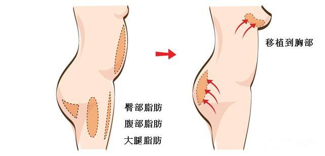 超声波自体脂肪丰胸会反弹吗?950 超声波自体脂肪丰胸会反弹吗?950