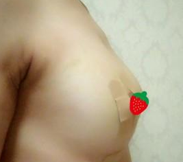 做了超声波自体脂肪丰胸后感觉乳房很饱满很立体497
