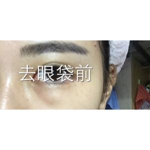 真人案例分享:做的超声波去眼袋988 真人案例分享:做的超声波去眼袋988
