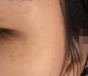 真人案例分享:做的超声波去眼袋988 真人案例分享:做的超声波去眼袋988