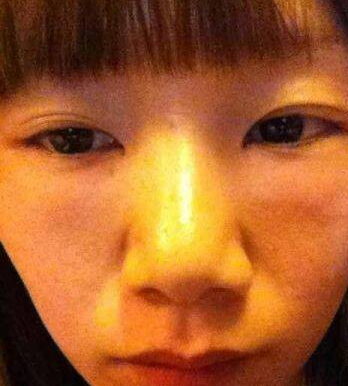 重庆超雅超 声 波去眼袋案例:眼袋没有le 重庆超雅超 声 波去眼袋案例:眼袋没有le