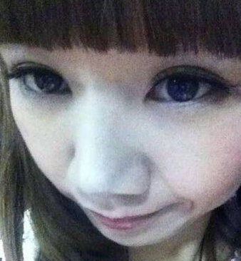 重庆超雅超 声 波去眼袋案例:眼袋没有le 重庆超雅超 声 波去眼袋案例:眼袋没有le