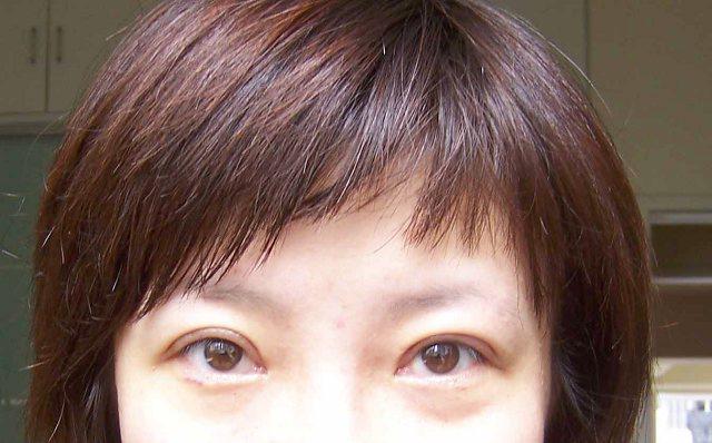 超声波双眼皮果然没让我失望，从此拥有炯炯有神的大眼睛！115