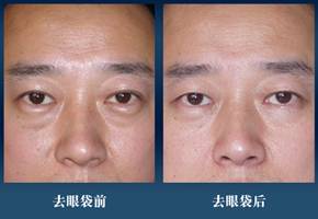超 声 波去眼袋——安全可靠、副作用少、价格合适 超 声 波去眼袋——安全可靠、副作用少、价格合适
