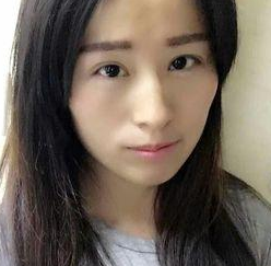 超 声 波去眼袋,效果不错,卧蚕很清晰 超 声 波去眼袋,效果不错,卧蚕很清晰