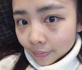 超声波去眼袋术后恢复分享,真人案例哦221 超声波去眼袋术后恢复分享,真人案例哦221