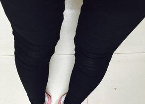 超 声 波减肥后大腿上得肉肉终于少le 超 声 波减肥后大腿上得肉肉终于少le