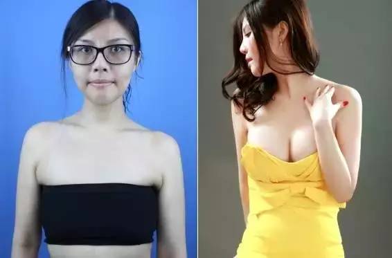 为什么劣质的乳房假体，会在你的胸腔里“爆炸”405