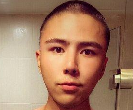 男生也做超声波双眼皮啦,真人案例900 男生也做超声波双眼皮啦,真人案例900