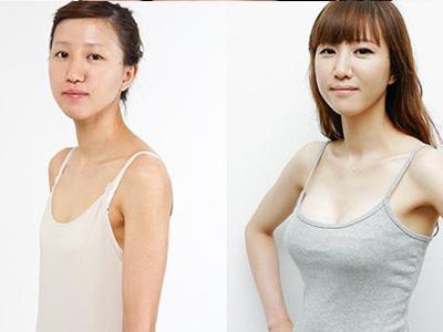 超声波自体脂肪丰胸安全不安全?678 超声波自体脂肪丰胸安全不安全?678