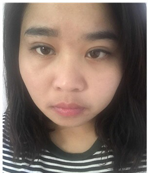 女生为了心爱的人做了超声波祛眼袋的手术132 女生为了心爱的人做了超声波祛眼袋的手术132