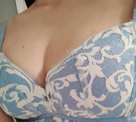 超 声 波自体脂肪丰胸真人案例分享，看平胸妹子得逆袭