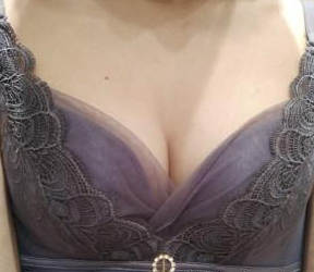 做完超声波自体脂肪丰胸后,乳房好坚挺啊!962 做完超声波自体脂肪丰胸后,乳房好坚挺啊!962
