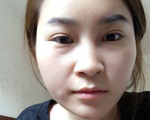 超声波去眼袋是个什么梗?我来说说吧。829 超声波去眼袋是个什么梗?我来说说吧。829