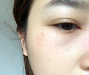 超声波去眼袋让显老眼袋拜拜!263 超声波去眼袋让显老眼袋拜拜!263